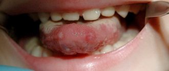 Burn of the oral cavity in a child.