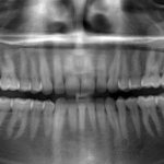 Panoramic photo of teeth