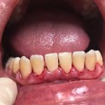 Periodontitis