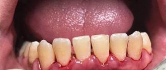 Periodontitis