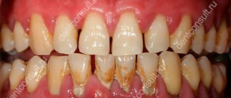 periodontitis