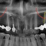 Perforation of the maxillary sinus