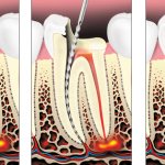 Periodontitis treatment