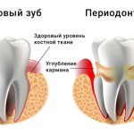 периодонтит