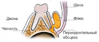 Periostitis is an inflammatory process in tooth tissues