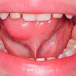 Plastic surgery of the frenulum of the tongue