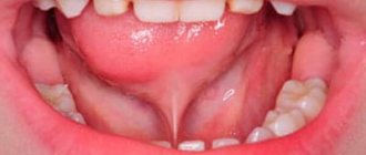 Plastic surgery of the frenulum of the tongue