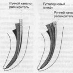 Root canal filling using lateral condensation method