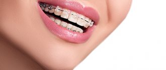 details about the combined braces system