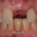 Post-extraction sockets of single-rooted teeth: classification and restoration protocols