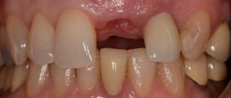 Post-extraction sockets of single-rooted teeth: classification and restoration protocols