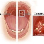 признаки тонзиллита