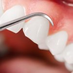 Probiotics to restore oral microflora and treat inflamed tissues