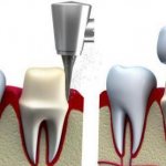 The process of installing a crown on a living tooth