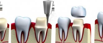 Процесс установки коронки на живой зуб