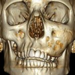 Prognosis for treatment of jaw dysplasia