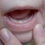 Прорезывание зуба у ребенка