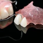 dentures for teeth vertex