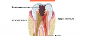 Pulpitis of the tooth in pictures