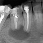 radicular cyst