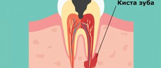 location of the dental cyst