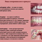 Common types of bite pathologies