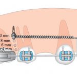размер ортодонтических мини имплантов