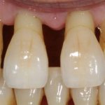 Gum recession due to periodontitis