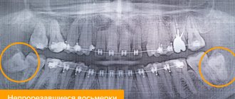 Рентген с непрорезавшимися восьмерками