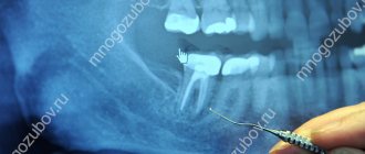 X-ray of a tooth with bifurcation