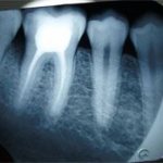 X-ray of a tooth