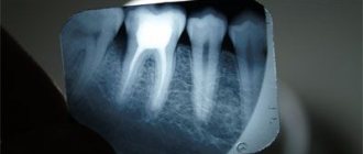 Рентген зуба
