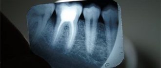 X-ray of a tooth