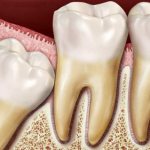 Ретированный зуб