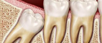 Ретированный зуб
