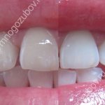 Result of whitening with toothpaste