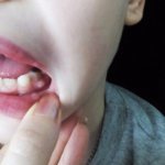 lump on the gum above the tooth