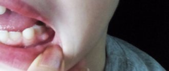 lump on the gum above the tooth