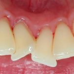 Скрученность зубов
