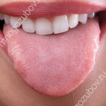 Teeth marks on the tongue