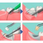 Complex removal of the lower wisdom tooth