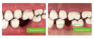 смещение зубов после удаления