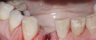 Condition of the gums after tooth extraction.jpg
