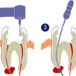 способы лечения зубной кисты