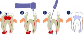 способы лечения зубной кисты