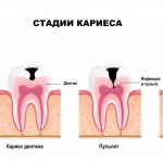 Stages of caries.jpg