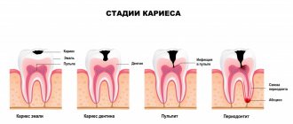 Stages of caries.jpg