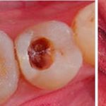 stages of caries