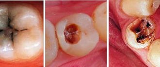 stages of caries