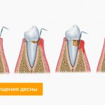 Stages of receding gums in pictures